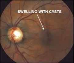 Define These Abbreviations Commonly Used in Ophthalmology Flashcards - Flashcards