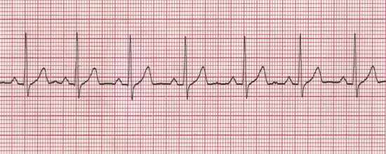 Explain the Various Kinds  ECG RHYTHMS Flashcards - Flashcards