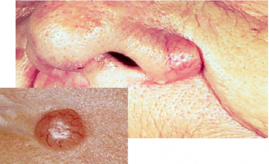 Identify the Following Dermatology Flashcards - Flashcards