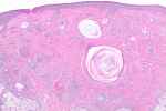 Desmoplastic Trichoepithelioma - Flashcard