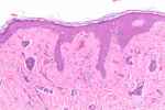 Desmoplastic Trichoepithelioma - Flashcard