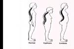 Describe Lardosis And Kyphosis  - Flashcard