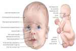 Clinical Syndromes Of Noonan Syndrome - Flashcard