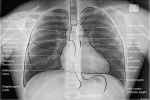 
CARDIAC DIAGNOSTICS
Chest X-Ray - Flashcard