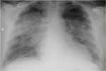 CARDIAC DIAGNOSTICS
Pulmonary Edema - Flashcard