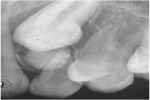 Hyperdontia (Supernumerary Teeth) - Flashcard