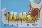 Odontogenic Cyst - Flashcard