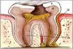 Dental Caries Definition - Flashcard