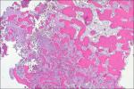Histology Of The Periapical Cemental Dysplasi... - Flashcard
