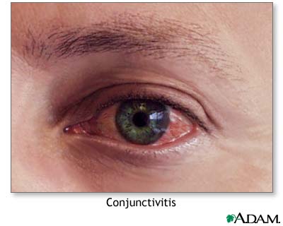 CONJUNCTIVITIS - Flashcard