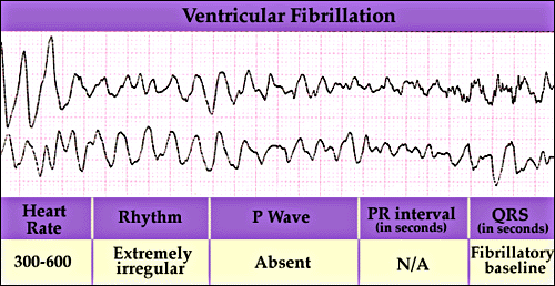 What Does Ventricular Fibrulation Look Like O... - Flashcard