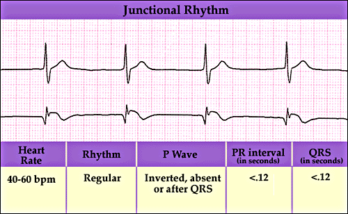What Does A Junctional Rythm Look Like? - Flashcard
