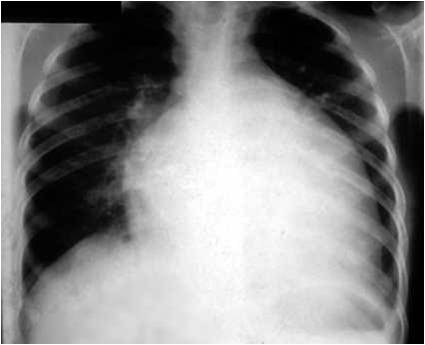 Dilated Cardiomyopathy What Is The Defec... - Flashcard