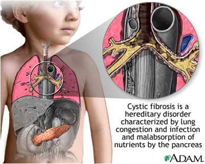 Cystic Fibrosis-mode Of Inheritance?-What Is ... - Flashcard