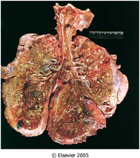 CF: Bronchiectasis-what Leads To This Disorde... - Flashcard