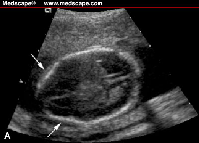 Arnold Chiari II Malformation - Flashcard