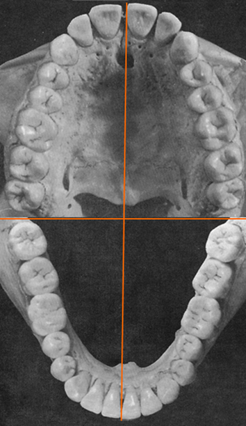 Different Quadrant Of Teeth - Flashcard