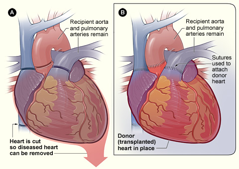 Are Your Arteries Also Removed In Heart Trans... - Flashcard