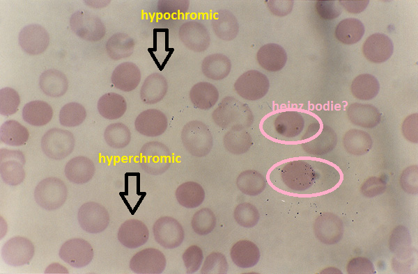 What Does A Hyperchromic Cell Look Like Vs A ... - Flashcard