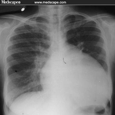 CXR Practice - Flashcards