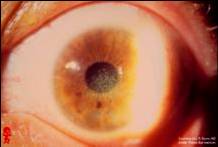 Corneal Disease - Flashcards