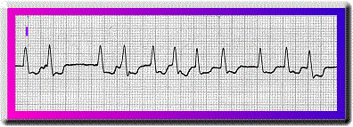 Atrial Fibrillation - Flashcard