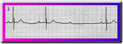 Wenckbach - Flashcard