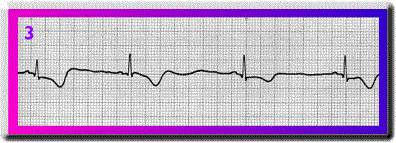 Sinus Bradycardia With Sinus Dysrhythmia - Flashcard