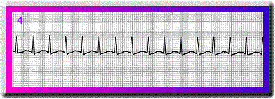 Atrial Tachycardia - Flashcard