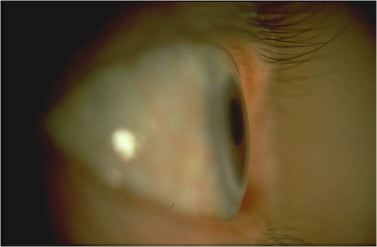 Ocular Disease Midterm 1 - Quiz