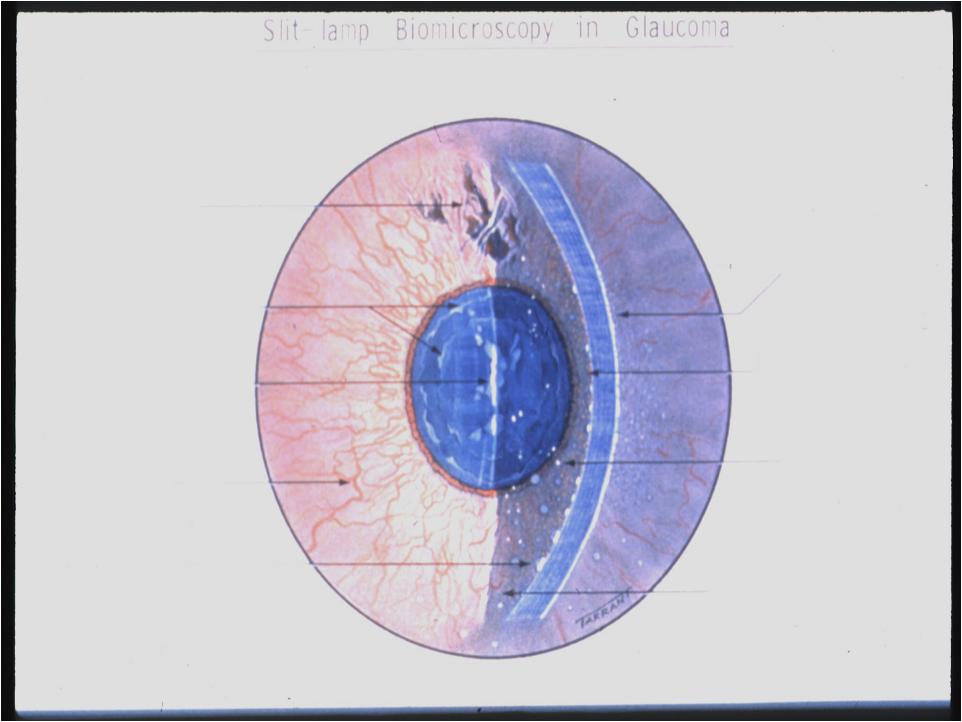 Glaucoma Risk Factors - Quiz