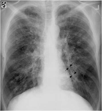 CF: Bronchiectasis-what Leads To This Disorde... - Flashcard