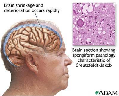 Creutzfeld Jacob Disease (1 Of 4 Related... - Flashcard