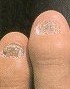 Atrophy Of The Nail PlateTreat By Stimulating... - Flashcard
