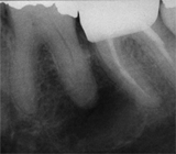 Oral Med Final Exam Radiographic Lesions Ch 20 - Flashcards