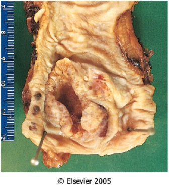 Diagnosis And Epidemiology Of Esophageal And Gastric Cancers - Quiz