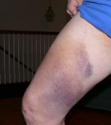 Contusion
Bruise/ An Injury To Part Of The B... - Flashcard