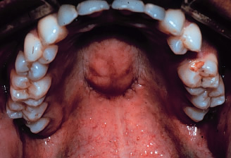 PALATAL TORUS - Flashcard