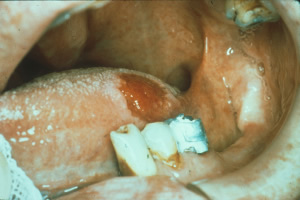 CROWN INFLAMMATION - Flashcard