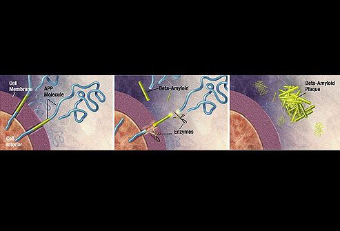 Pathogenesis Of AD - Flashcard