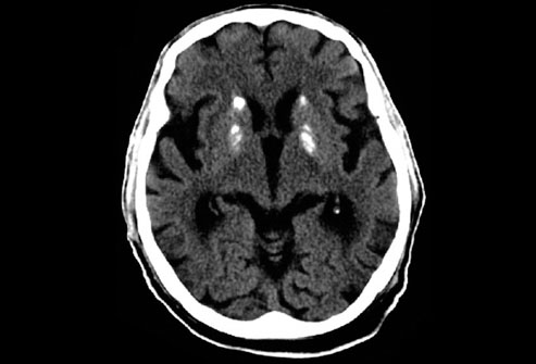 Ct Scan - Flashcard