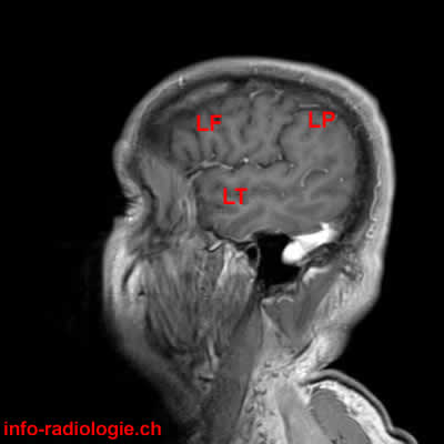 Mri Brain Images - Flashcards