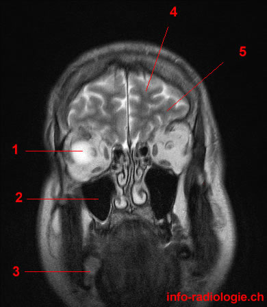 Coronal Brain - Flashcards