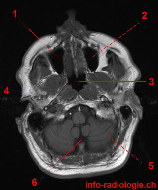 Identify These Mucopyocele of the Maxillary Sinus Flashcards - Flashcards