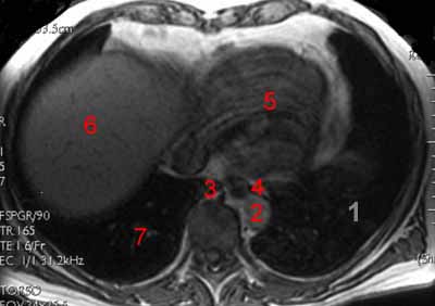 Axial Abdominal Images Flashcards - Flashcards