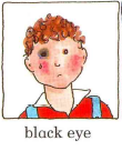 Black Eye - Flashcard