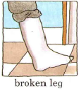 Broken Leg - Flashcard