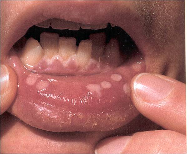 PD Mouth and Throat Pics - Flashcards