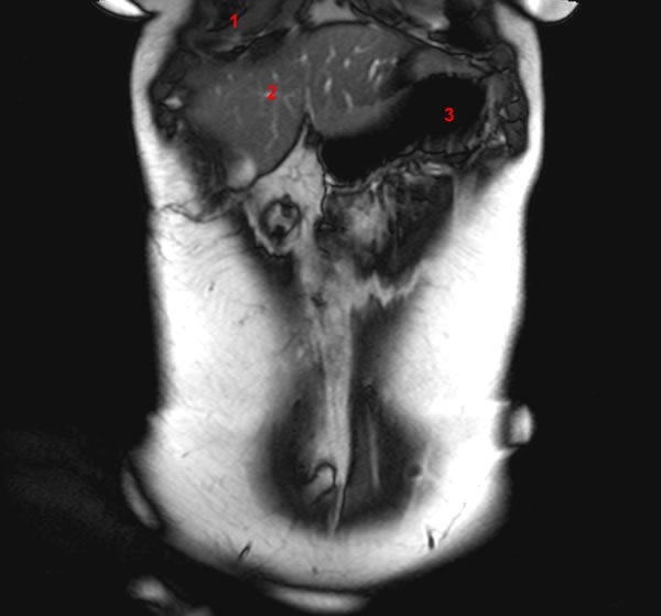 Mri Abdomen Coronal - Flashcards