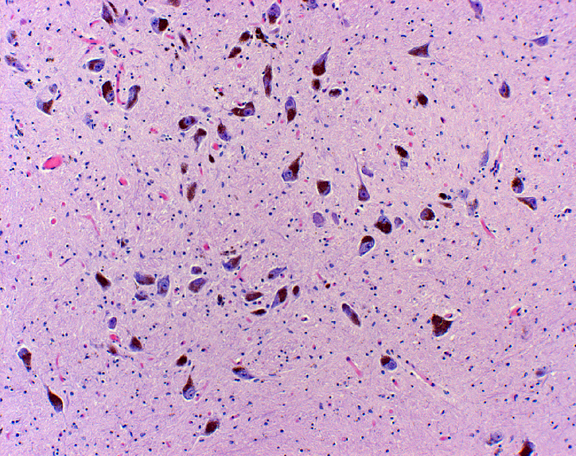 What Does This Brain Stain Show?  - Flashcard